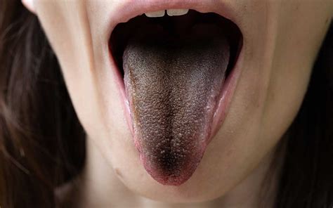 waking up with black tongue